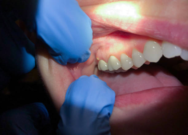Best Emergency Wisdom Teeth Removal in Ntgomery City, MO